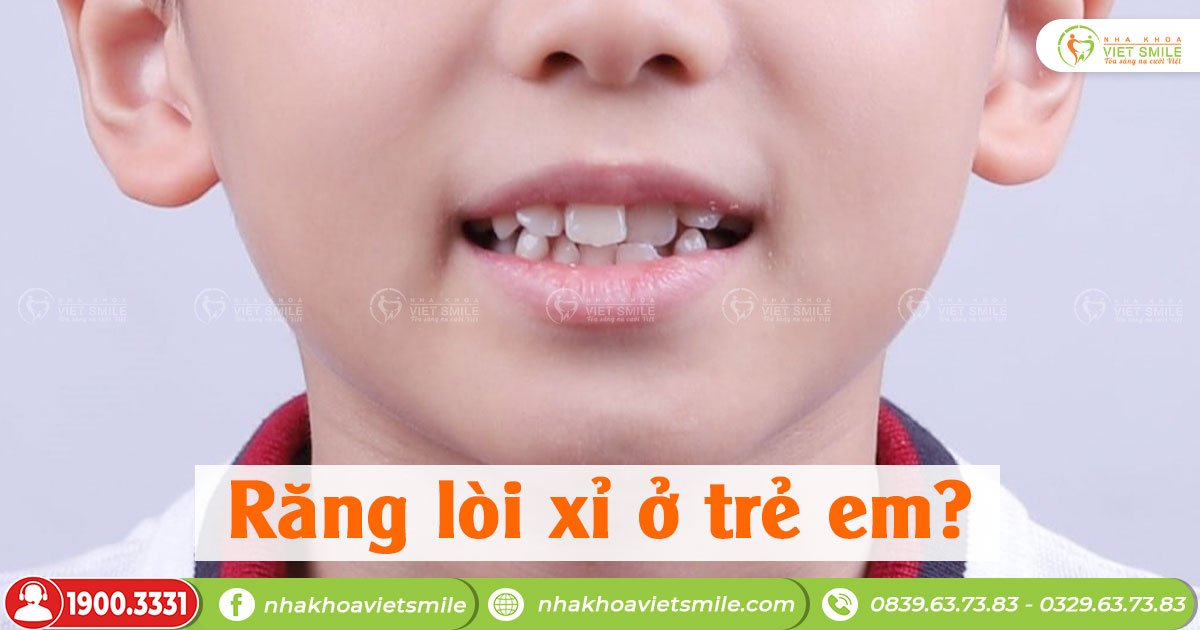Răng lòi xỉ ở trẻ em