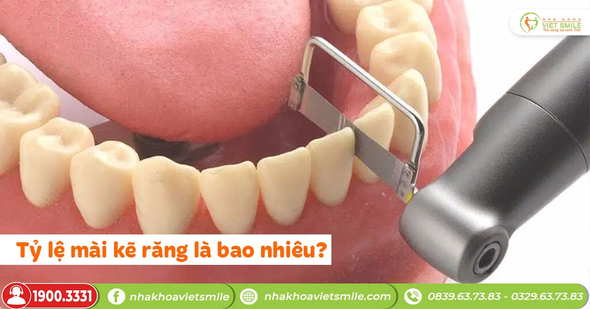 Tỷ lệ mài kẽ răng là bao nhiêu?