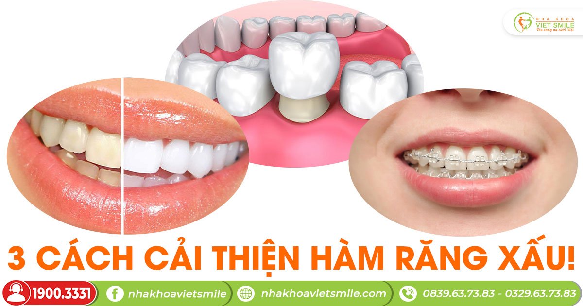 3 cách cải thiện hàm răng xấu!