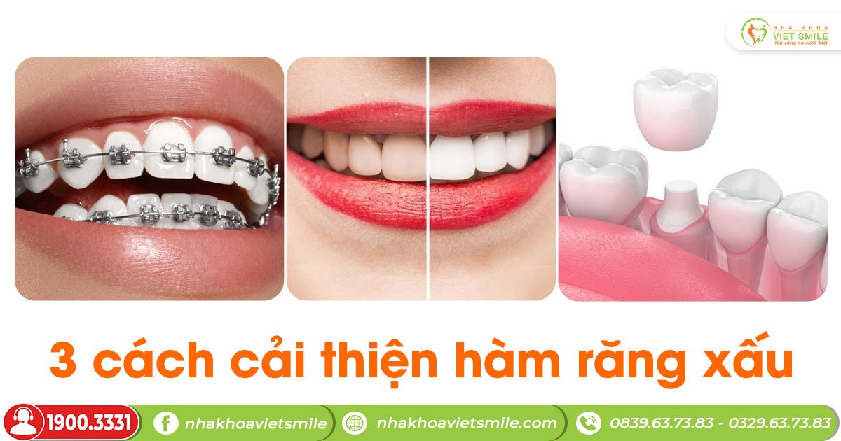 3 cách cải thiện hàm răng xấu!