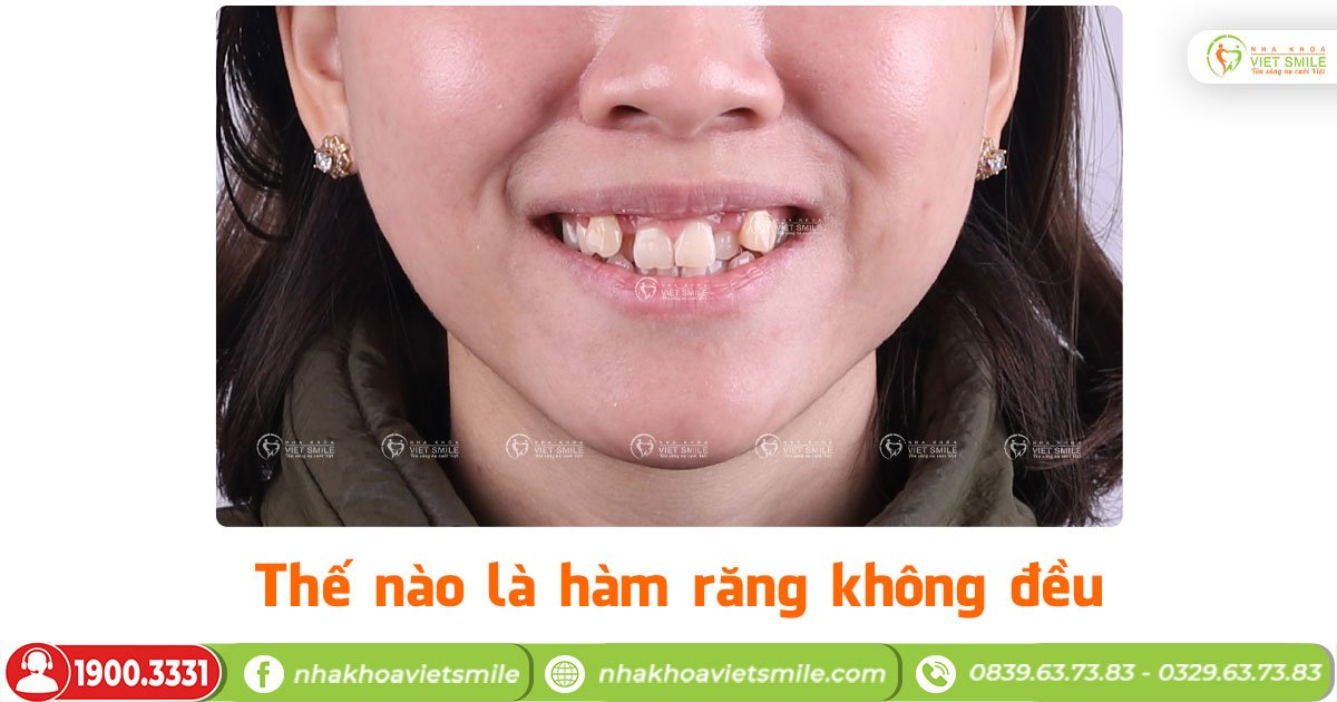 Thế nào là hàm răng không đều?