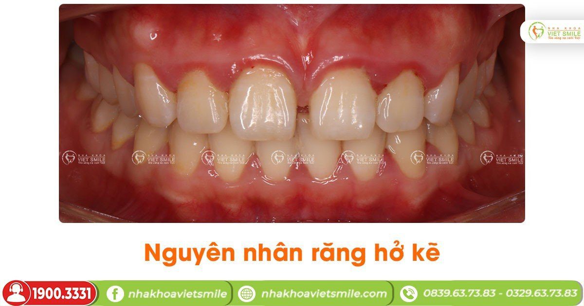 Nguyên nhân răng hở kẽ