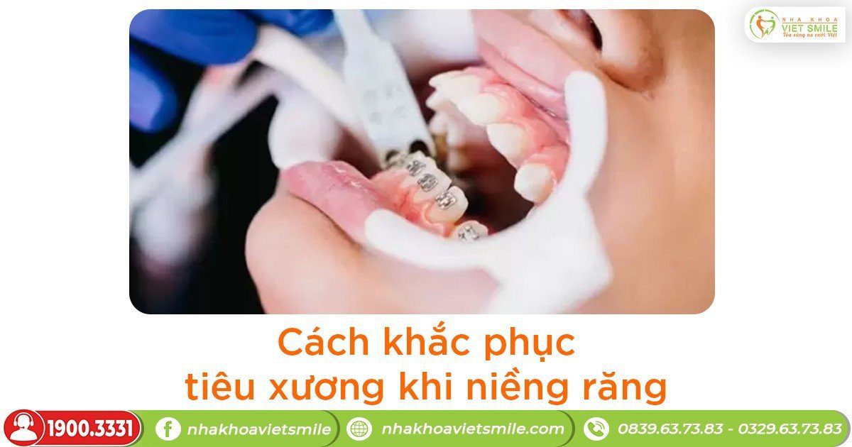 Cách khắc phục tiêu xương khi niềng răng