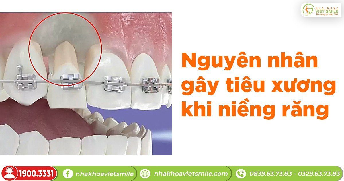 Nguyên nhân gây tiêu xương khi niềng răng!