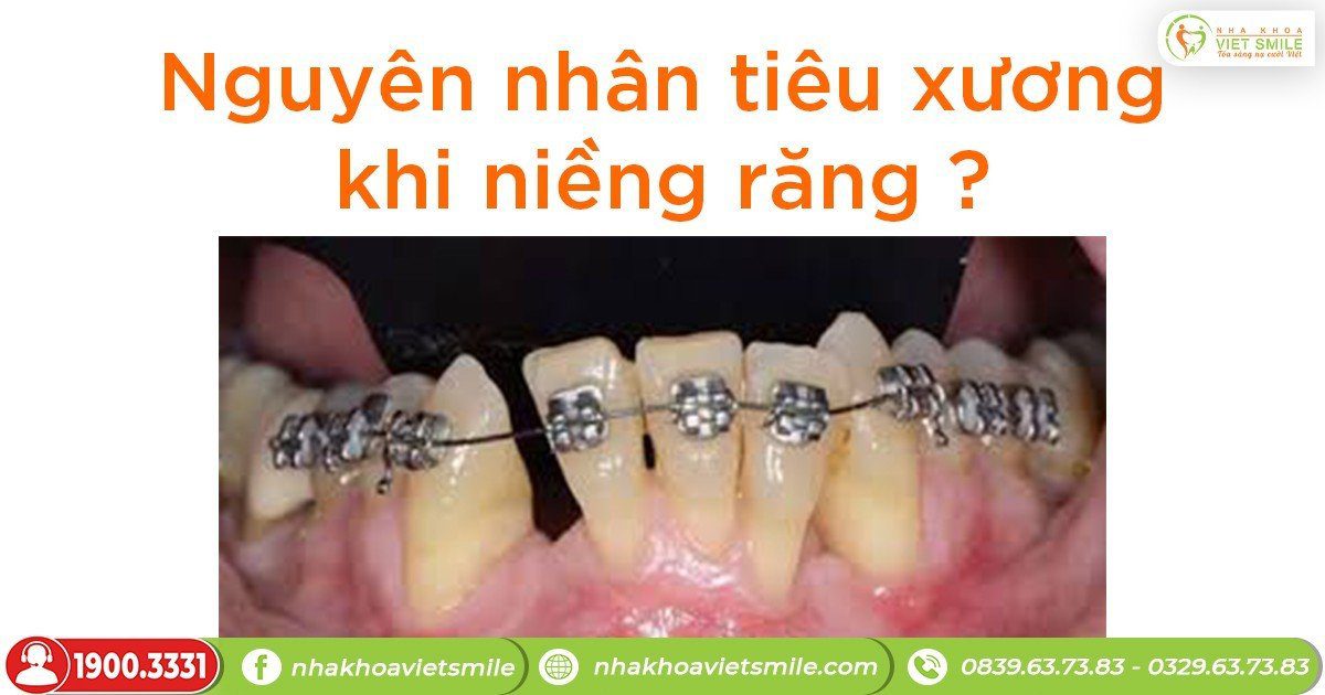 Nguyên nhân tiêu xương khi niềng răng?