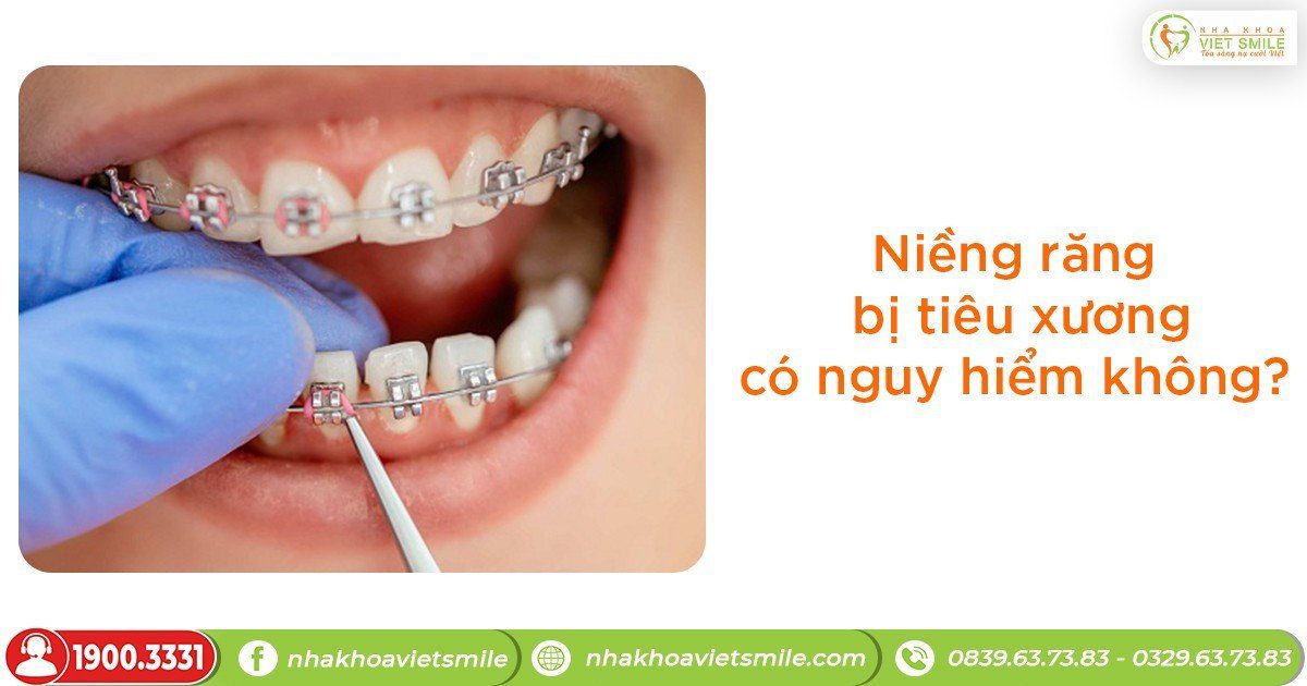 Niềng răng bị tiêu xương có nguy hiểm không?