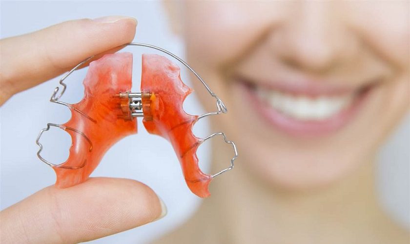 Cách giữ răng sau khi niềng răng