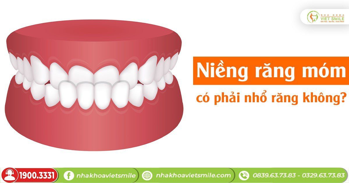 Niềng răng móm có phải nhổ răng không?