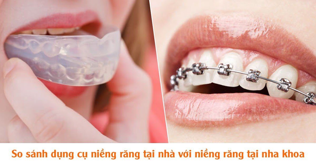 So sánh dụng cụ niềng răng tại nhà với niềng răng tại nha khoa