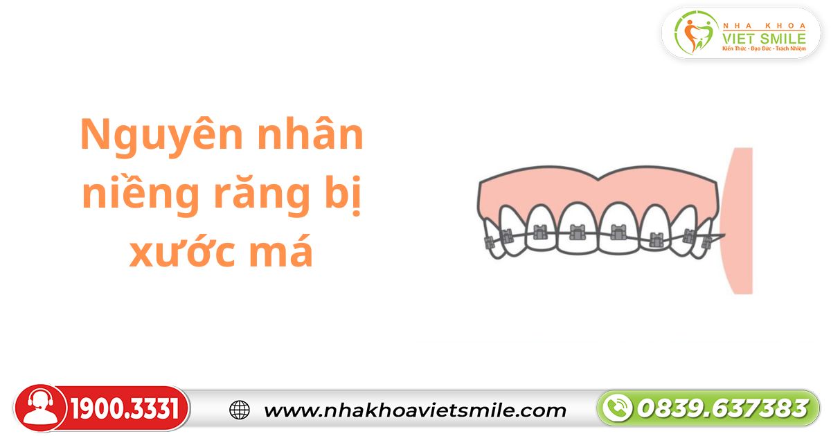 Nguyên nhân niềng răng bị xước má