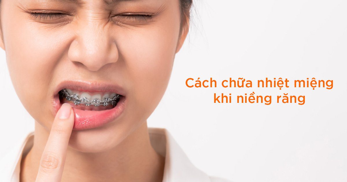 Cách chữa nhiệt miệng khi niềng răng