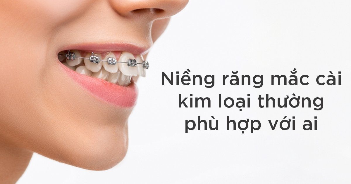 Niềng răng mắc cài kim loại thường phù hợp với ai