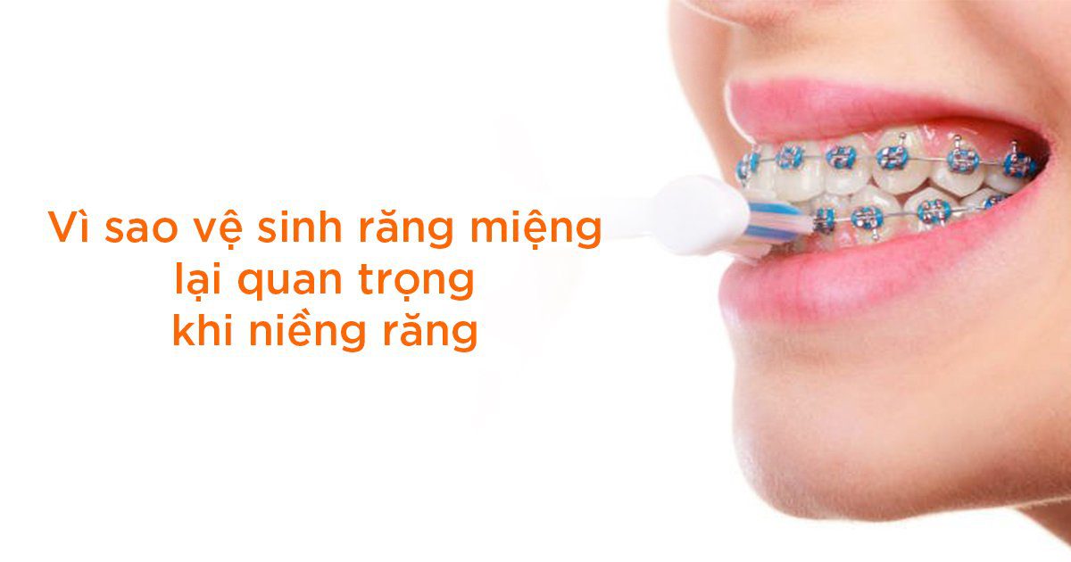 Vì sao vệ sinh răng miệng lại quan trọng khi niềng răng