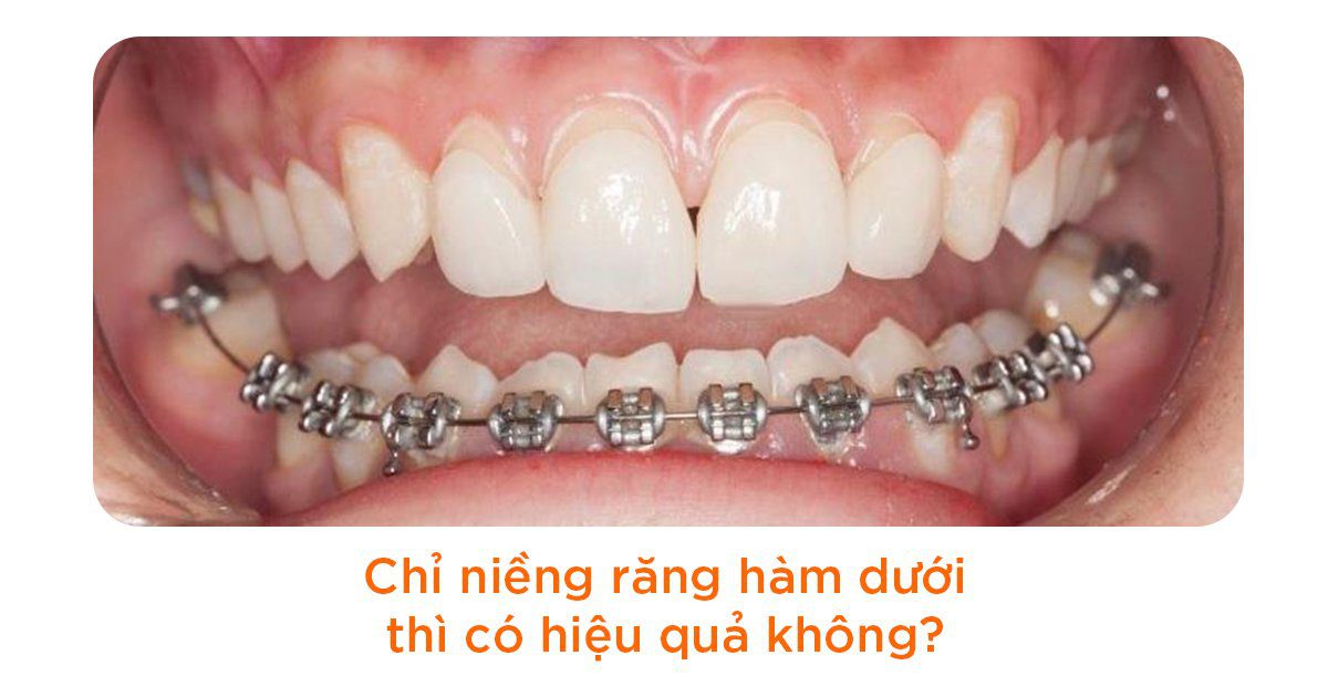 Chỉ niềng răng hàm dưới thì có hiệu quả không?  
