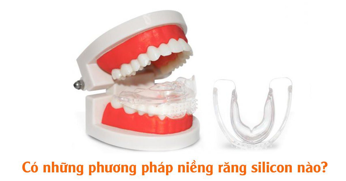 Có những phương pháp niềng răng silicon nào?