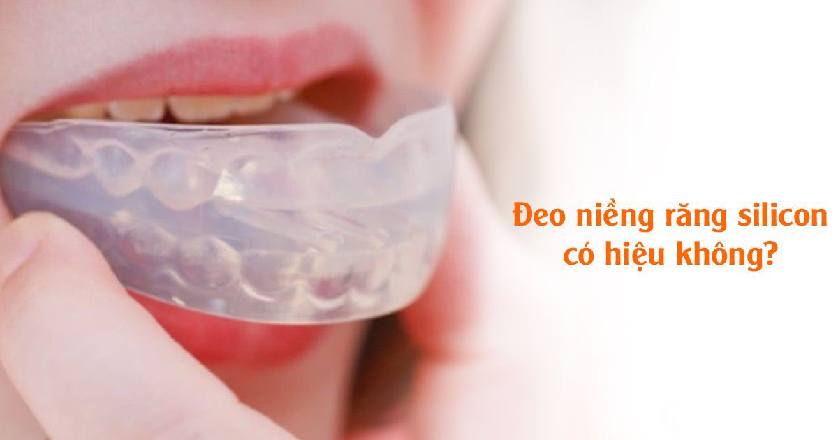 Đeo niềng răng silicon có hiệu quả không?