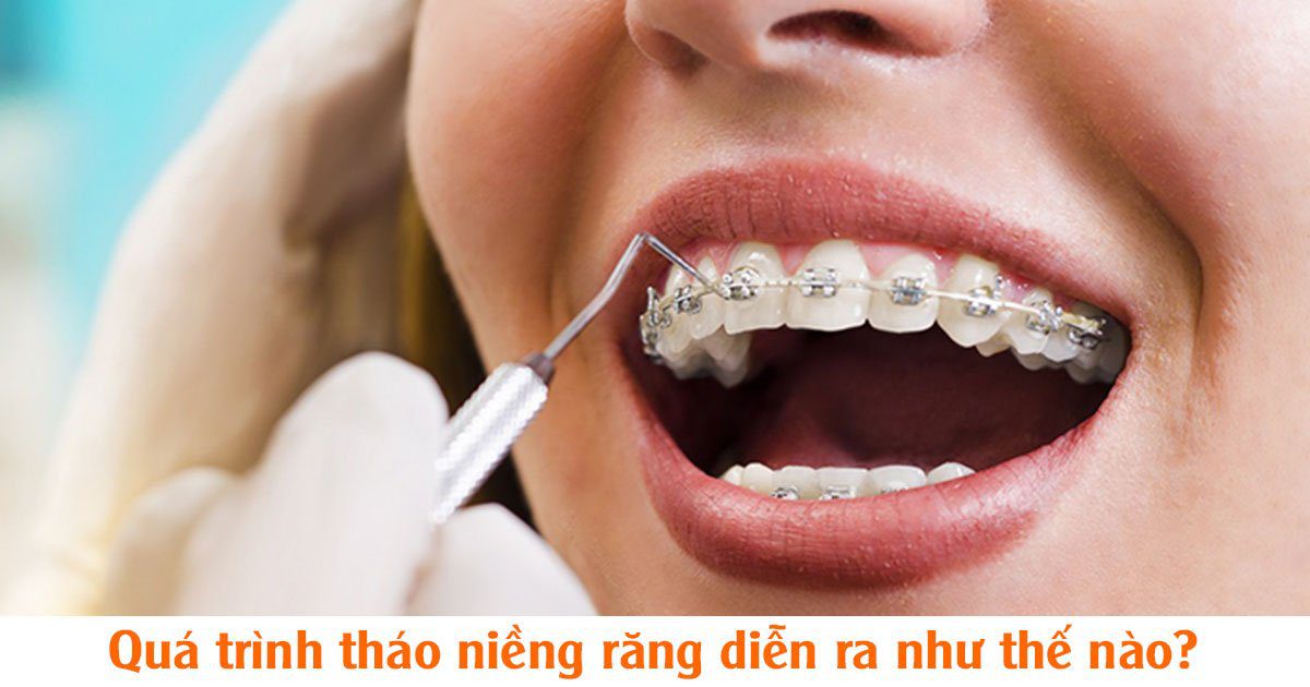 Quá trình tháo niềng răng diễn ra như thế nào?
