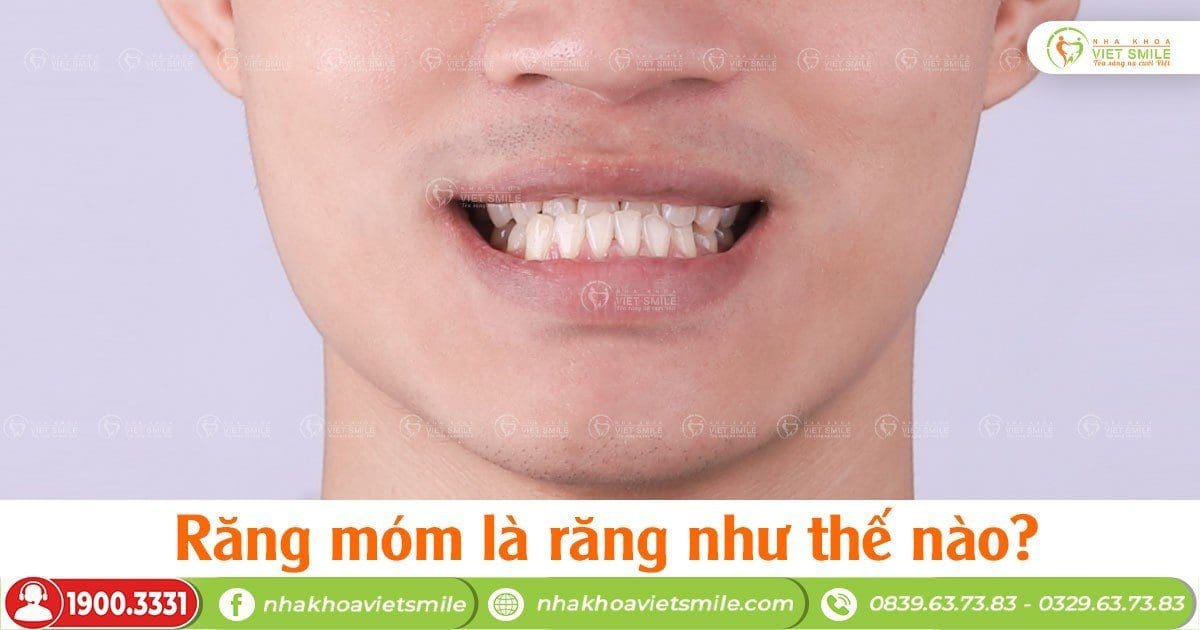 Răng móm là như thế nào