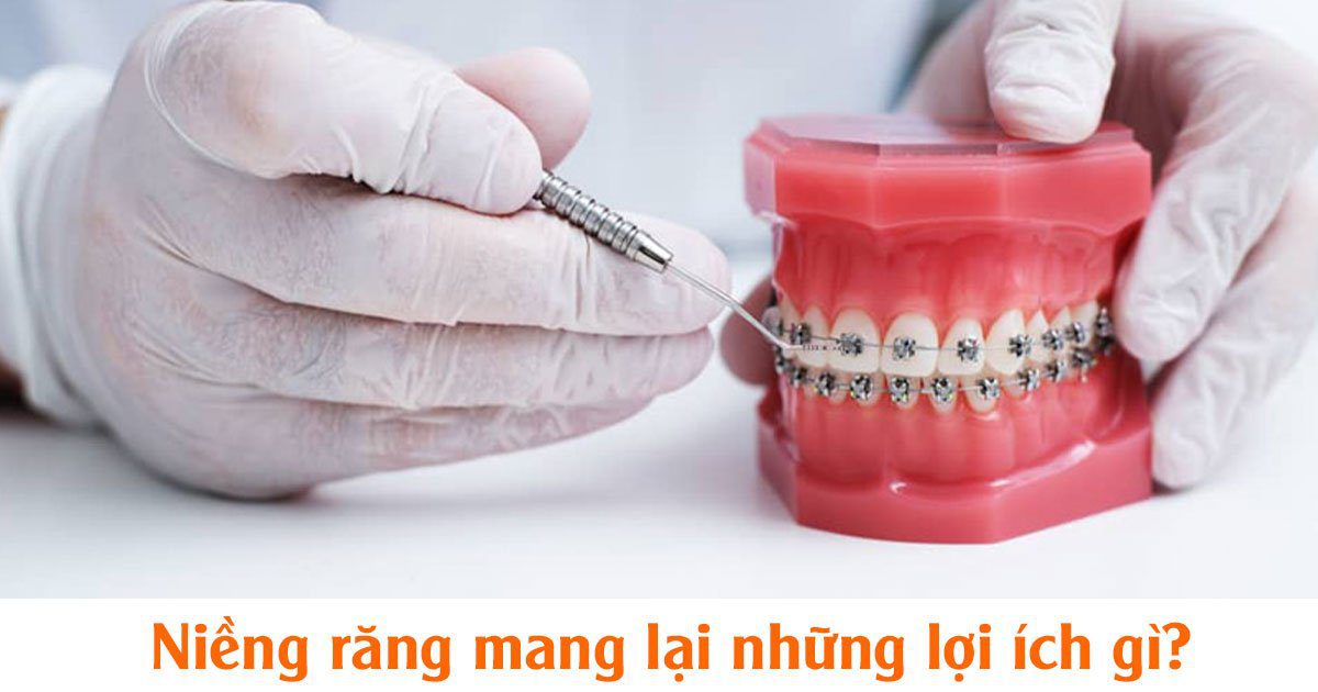 Niềng răng mang lại những lợi ích gì?