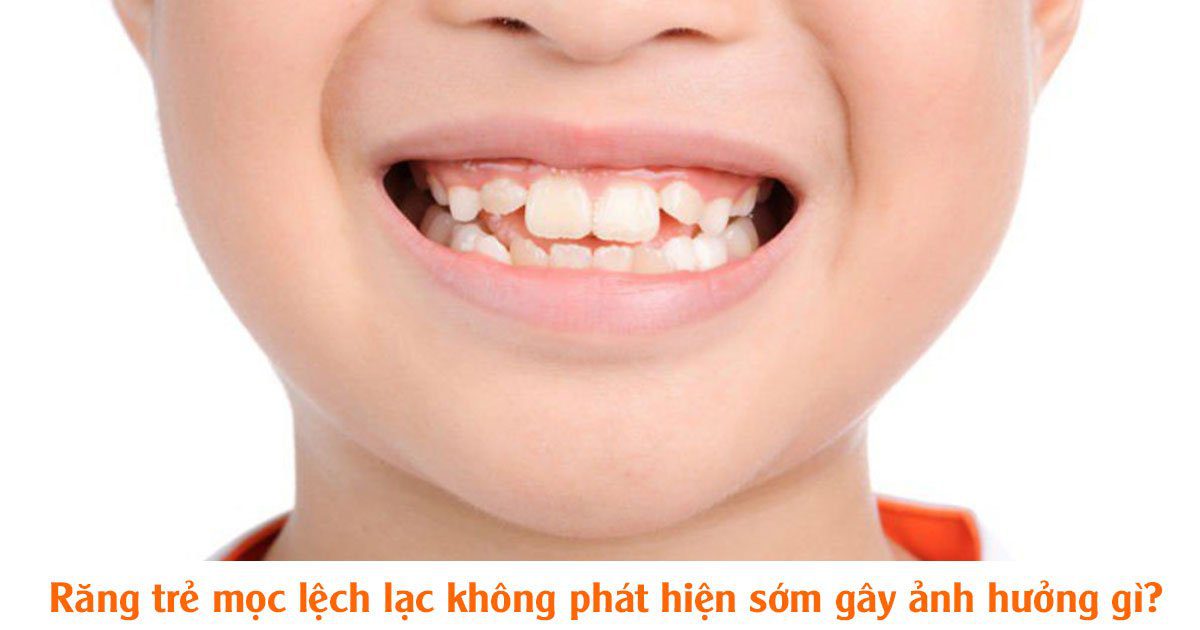 Răng trẻ mọc lệch lạc không phát hiện sớm gây ảnh hưởng gì?