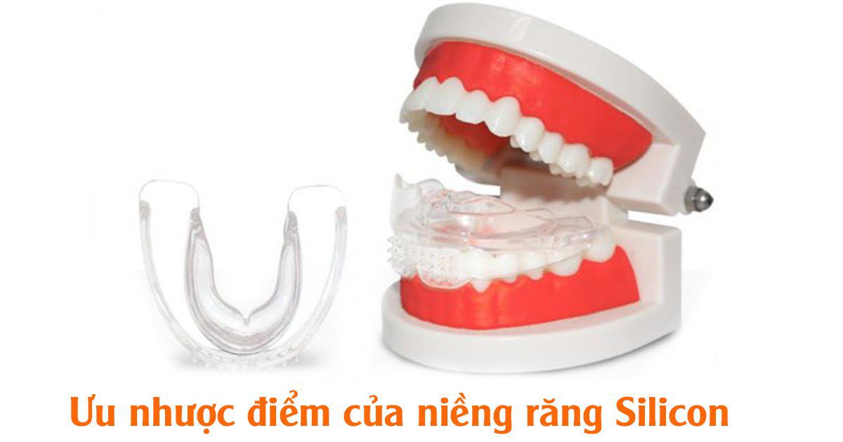 Ưu nhược điểm của niềng răng silicon