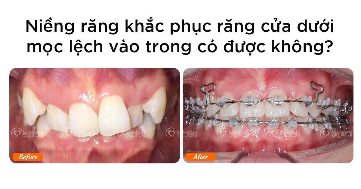 Niềng răng khắc phục răng cửa dưới mọc lệch vào trong được không?
