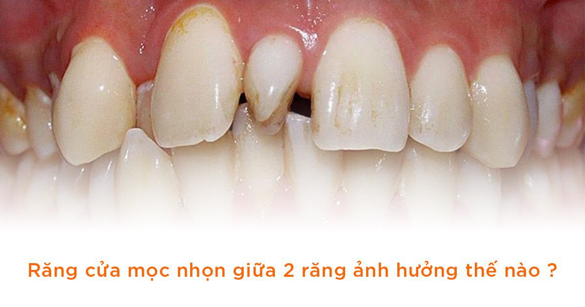 Răng cửa mọc nhọn giữa 2 răng ảnh hưởng thế nào?