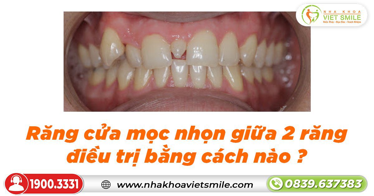 Răng cửa mọc nhọn giữa 2 răng điều trị bằng cách nào?