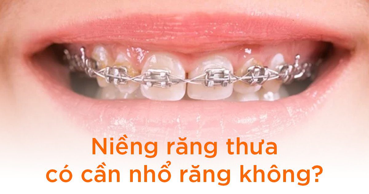 Niềng răng thưa có cần nhổ răng không?