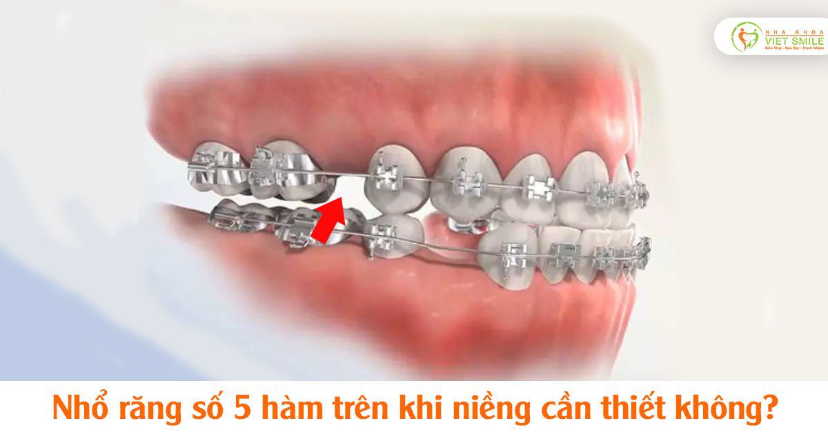 Nhổ răng số 5 hàm trên khi niềng cần thiết không?
