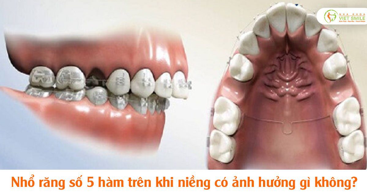 Hổ răng số 5 hàm trên khi niềng có ảnh hưởng gì không?