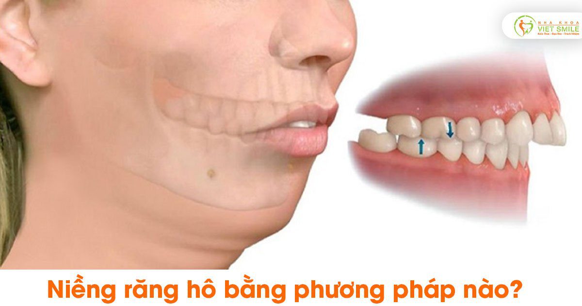 Vietsmile nieng rang ho bang phuong phap noa