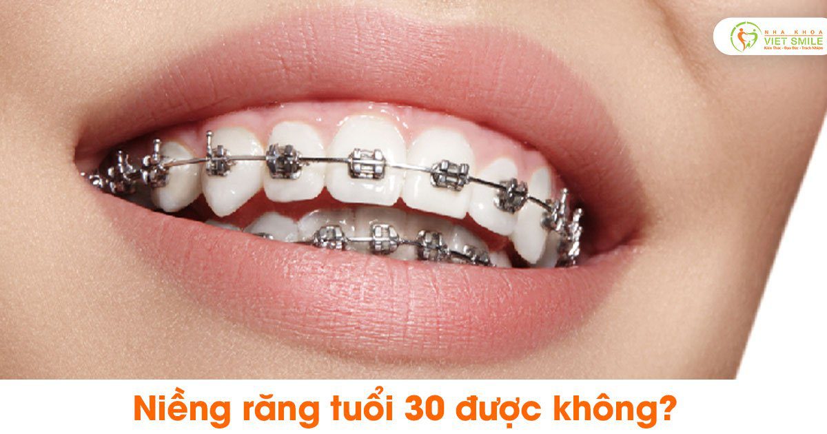 Lợi ích của niềng răng