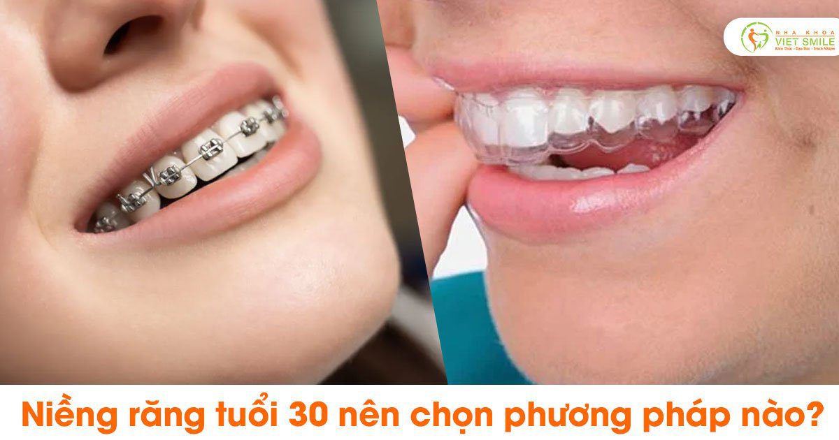 Vietsmile nieng rang tuoi 30 nen chon phuong phap nao