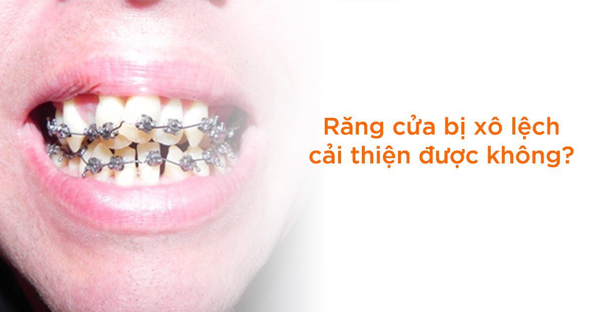 Vietsmile rang cua bi xo lech co cai thien duoc k