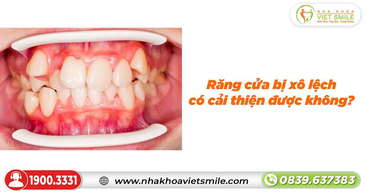 Răng cửa bị xô lệch có cải thiện được không?