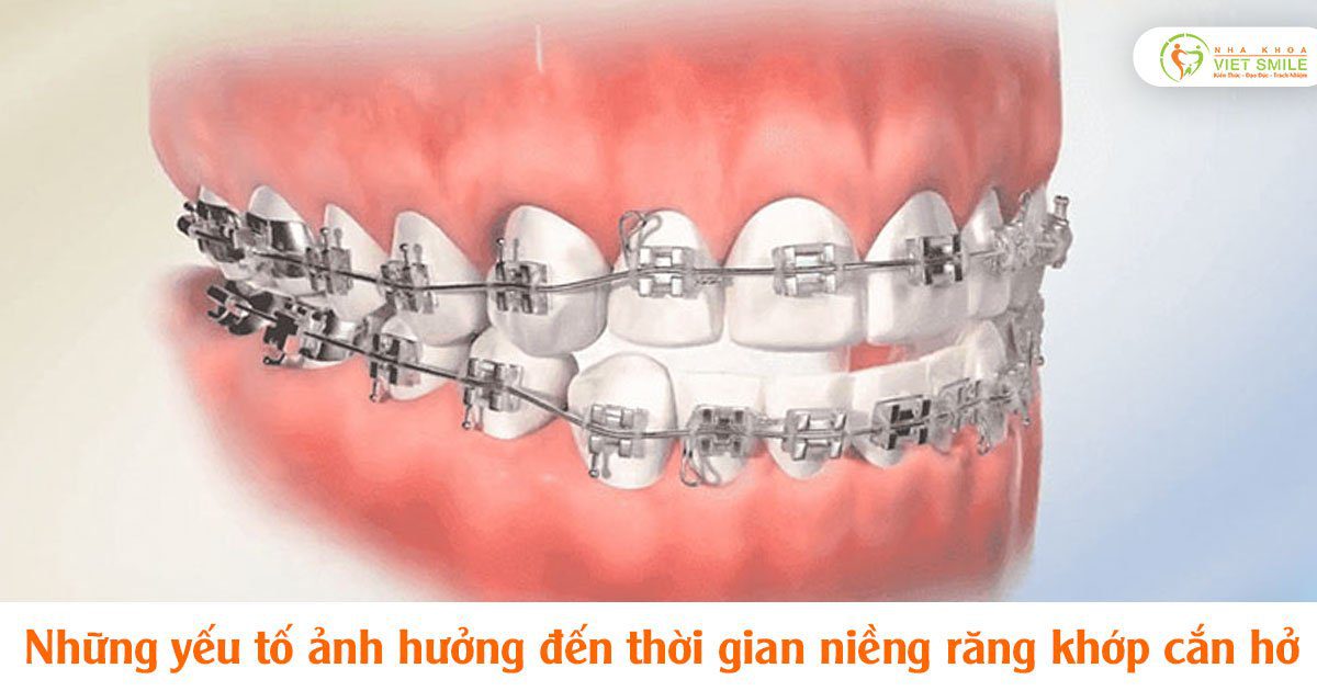 Những yếu tố ảnh hưởng đến thời gian niềng răng khớp cắn hở