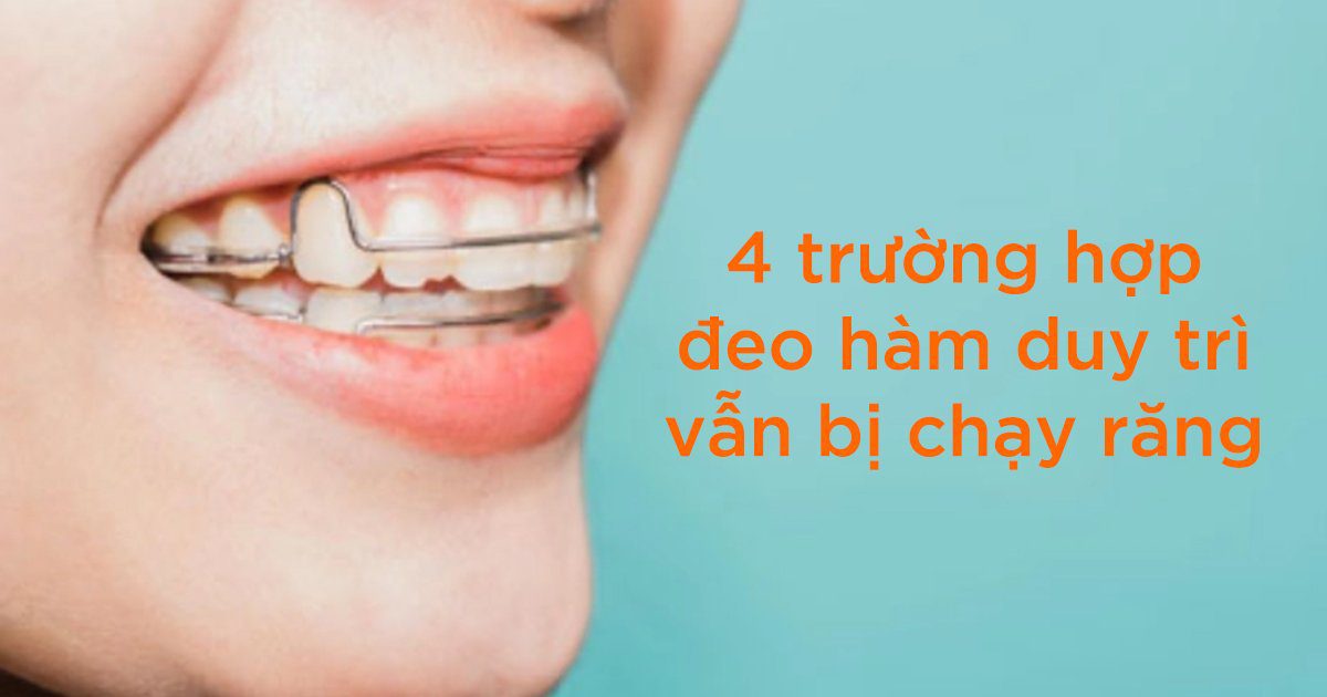 4 trường hợp đeo hàm duy trì vẫn bị chạy răng