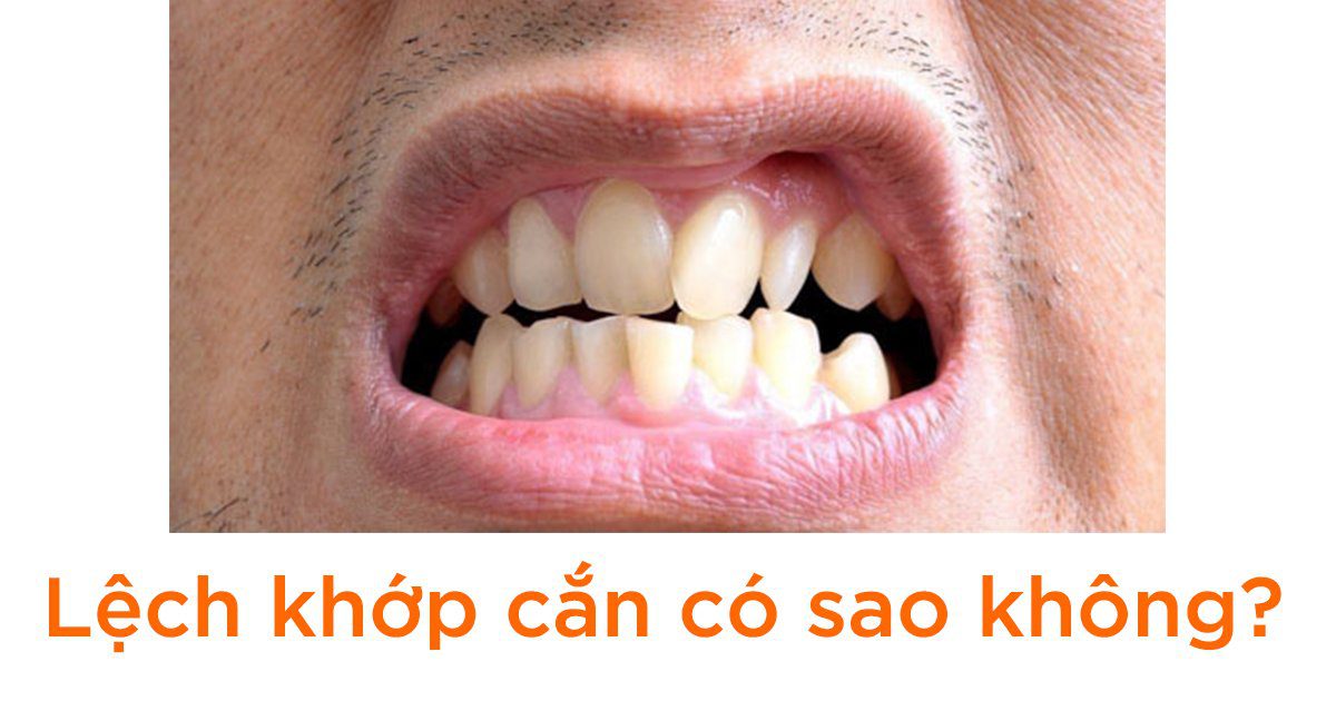 Lệch khớp cắn có sao không?