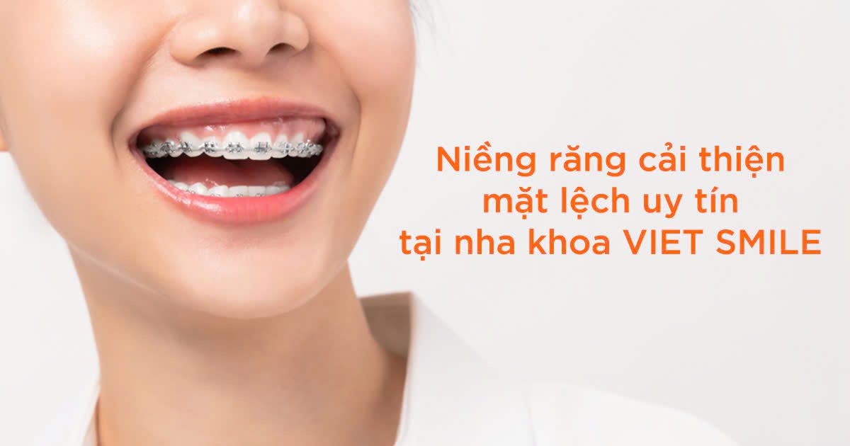 Niềng răng cải thiện lệch mặt uy tín tại nha khoa viet smile