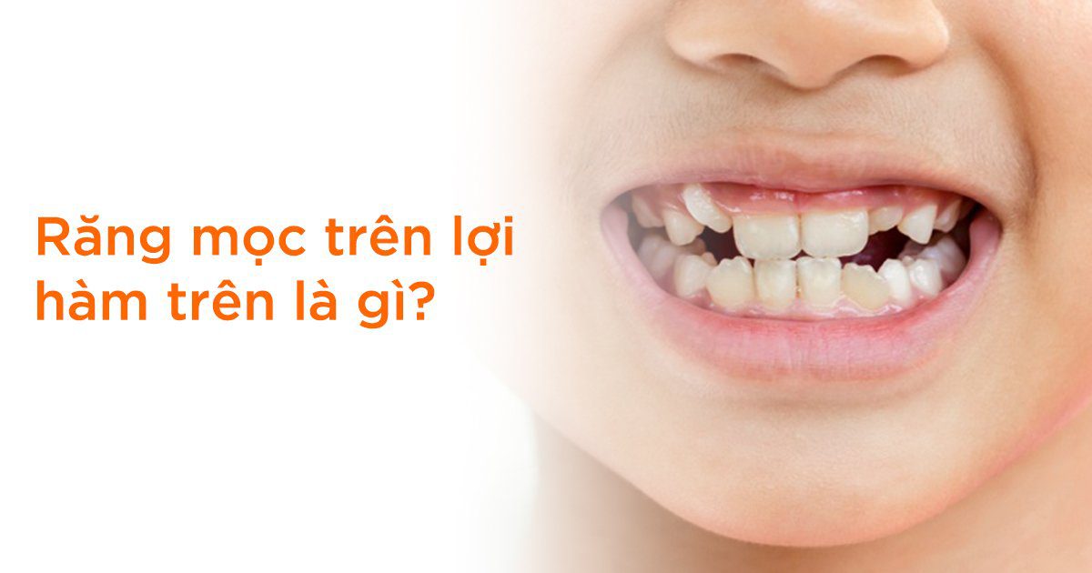 Răng mọc trên lợi hàm trên là gì?