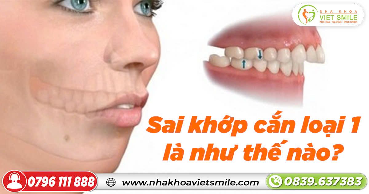 Sai khớp cắn loại 1 là như thế nào?