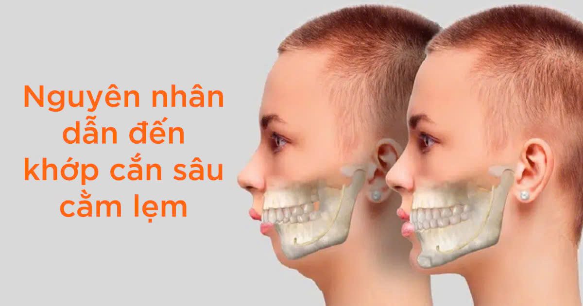 Nguyên nhân dẫn đến khớp cắn sâu cằm lẹm