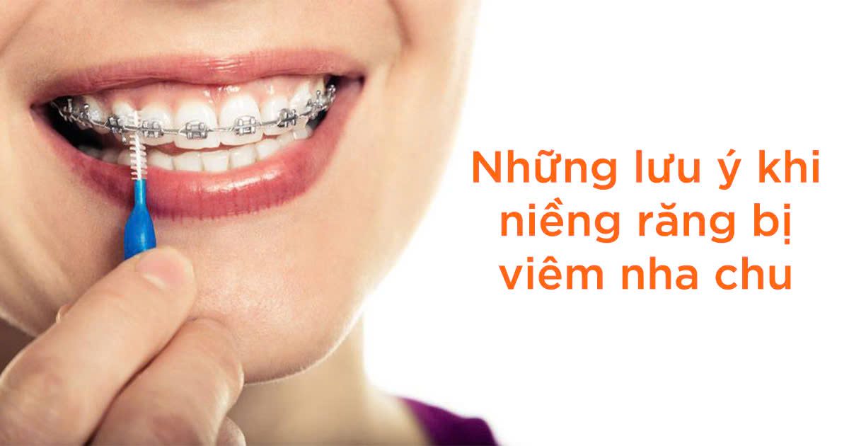 Những lưu ý khi niềng răng bị viêm nha chu