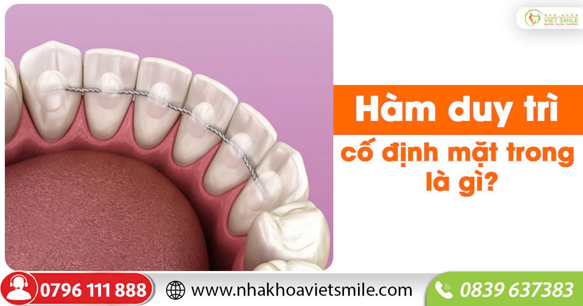 Hàm duy trì cố định mặt trong là gì? Ưu, nhược điểm