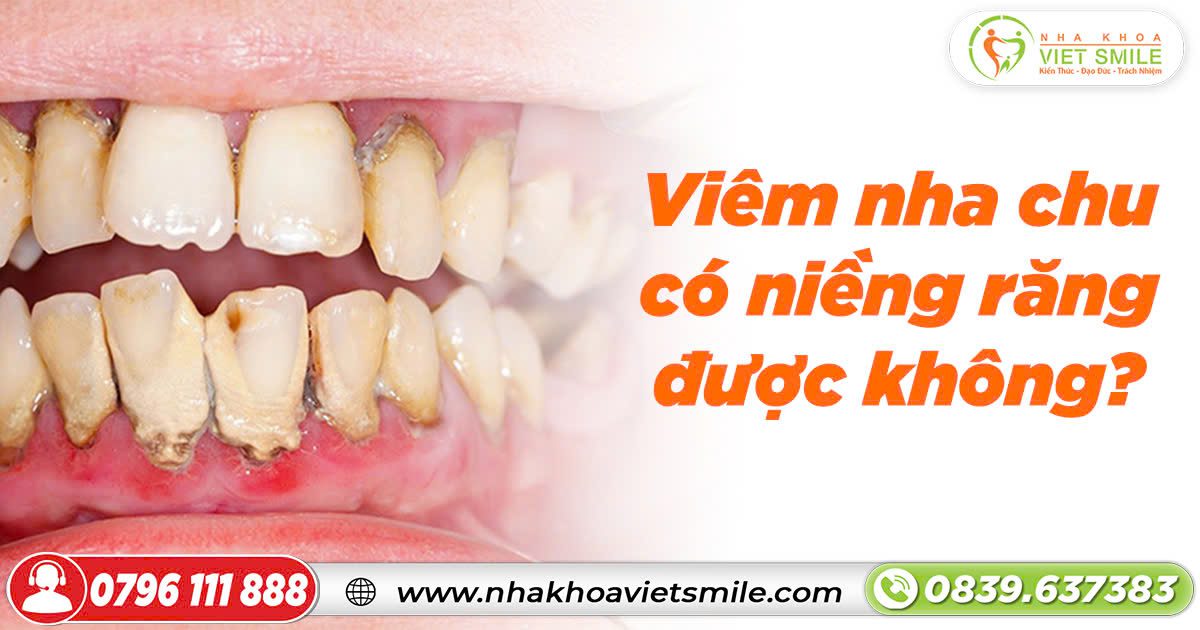 Viêm nha chu có niềng răng được không?