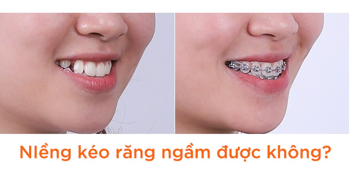 Niềng kéo răng ngầm được không?