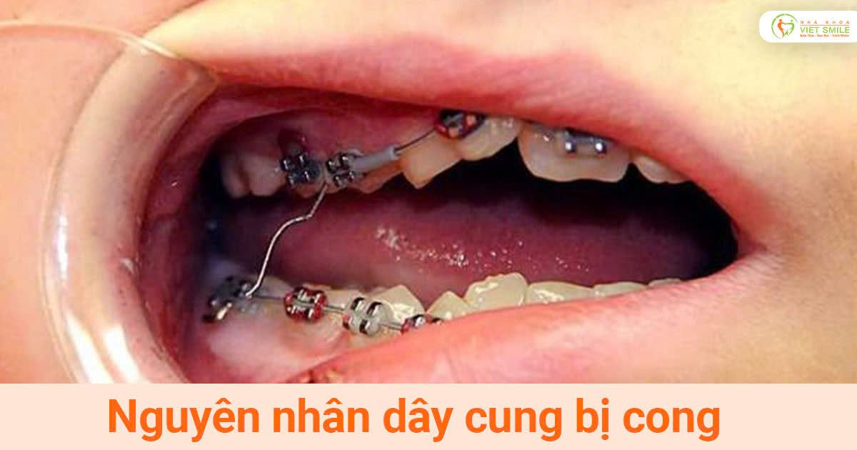 Nguyên nhân dây cung bị cong