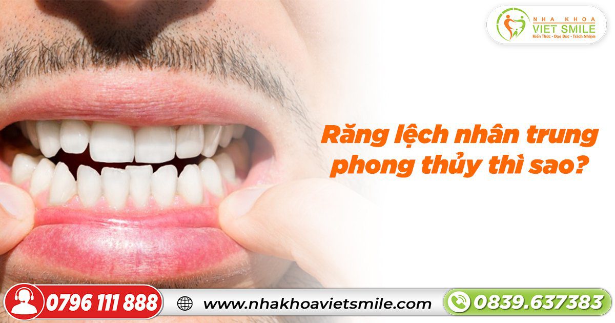 Răng lệch nhân trung phong thủy thì sao?