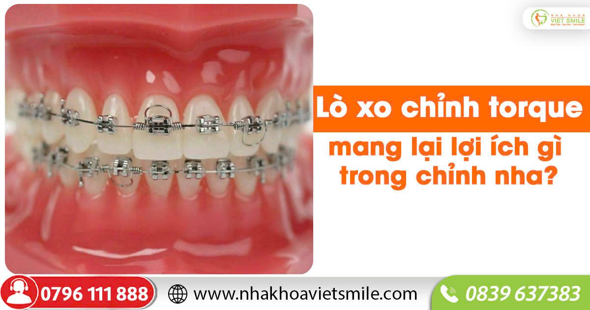 Lò xo chỉnh torque mang lại lợi ích gì trong chỉnh nha?